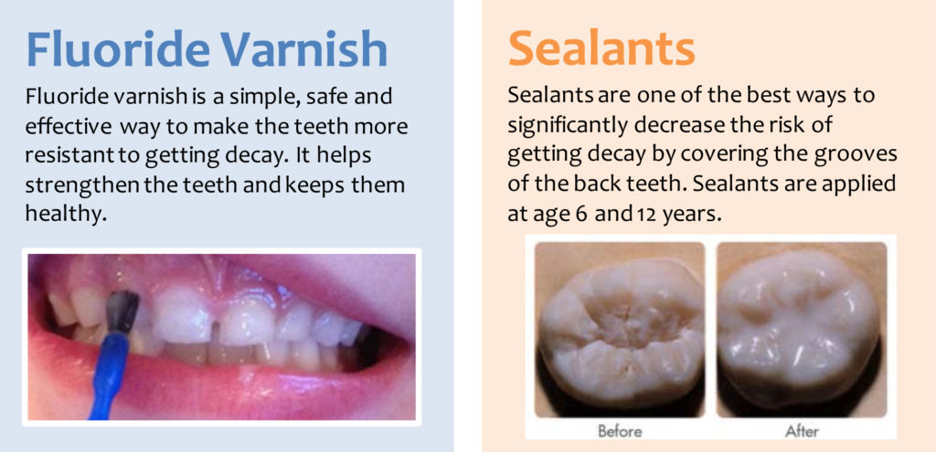 flouride varnish is painted on the front surface and sealants are applied to deep groves in back teeth. 